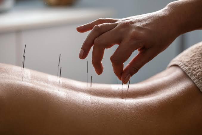 Acupuncture.jpeg